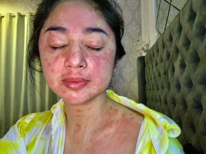 Kronologi Dewi Perssik Positif COVID-19 hingga Wajah dan Tubuh Merah-merah