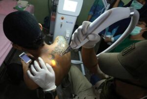 Hebat, BAZNAS Sumbawa Barat dan Zeanov Care Berikan Masyarakat Biaya Hapus Tato Gratis