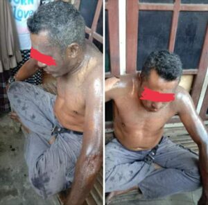 Gegara Menyuruh Goreng Ikan, Istri Tega Siram Suami Pakai Minyak Panas