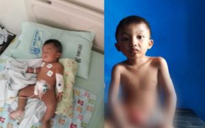 Adam, Anak 6 Tahun Penderita Ekstrofi Kandung Kemih di Batulayar Lombok Barat Butuh Bantuan