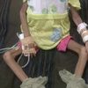 Anak 3 Tahun di Bima Alami Gizi Buruk, Berat Badan Hanya 5 Kg, NTBCARE Desak pemda dan Pemprov NTB Bergerak Cepat